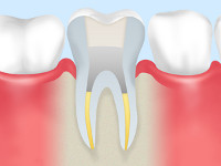 【STEP5】歯の芯を入れる